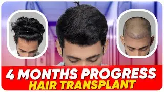 Hair Transplant in Malaysia | Best Results & Cost of Hair Transplant in Malaysia