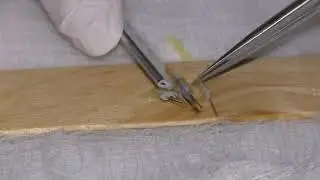 Dallas Hair Transplant Coordinator Emina Vance Demonstrates Quality Graft Dissection