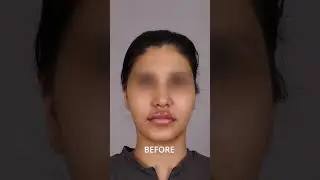 Jawline Transformation: Before & After Results | Dr. Shruti Marwah  #shorts #shortsfeed