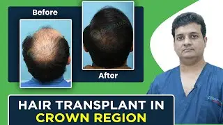 🌟 Crown Area Hair Transplant India || Crown Hair Transplant Result Before After #askdermalife