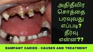 அதி தீவிர சொத்தை பற்களில் பரவுவது எப்படி? தீர்வு என்ன? - Rampant caries causes and treatment