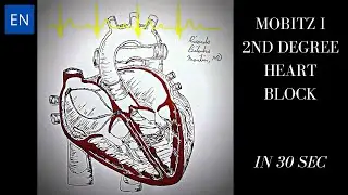 Mobitz I 2nd Degree Heart Block - Animation and ECG
