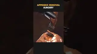 Appendix Removal Surgery | Dr. Shambhav Chandra