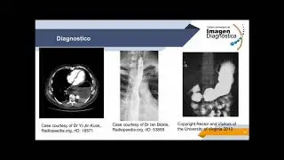 Hernia Hiatal
