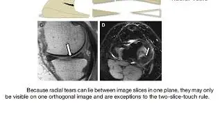 Meniscal tears
