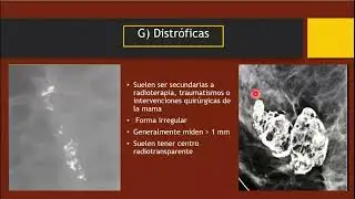 Calcificaciones - BIRADS