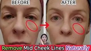 Mid Face Lift Massage 💆&zwj;♀️ Remove Mid Cheek Lines & Lift Sagging Face Naturally | Anti-Aging Routine