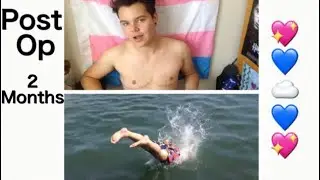 Top Surgery Update: 2 Months Post Op + First Time Swimming Shirtless