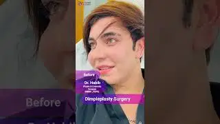 🌟 Dimpleplasty Surgery | Before & After Result | Dr. Habib 😍✨
