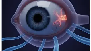 STOP BLINDNESS NOW! Understanding Glaucoma Before It's Too Late.