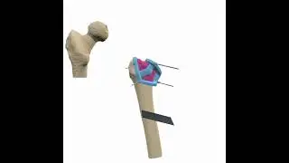 A single patient-specific guide for several complex surgical steps! 💪