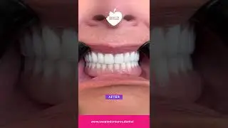 Judy's Snap In Dentures Before & After 🦷😱 #implants #smile