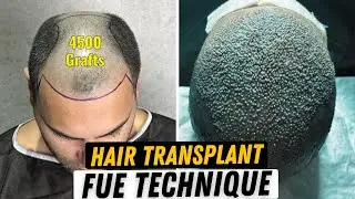 Пересадка волос, 4500 графтов, техника FUE #hairtransplantturkey #hairlosstreatment