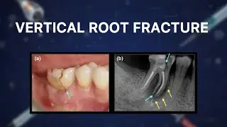 VERTICAL ROOT FRACTURE 