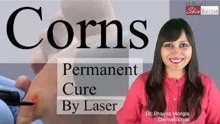 Best treatment for Corn | Permanent cure for Corn | Dr Bhavna Mangla (Skin Mantraa)