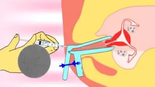 Intrauterine insemination (IUI) video.flv about infertility and ivf treatment