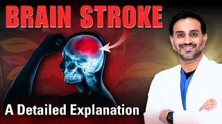Brain stroke symptoms & treatment | brain stroke and paralysis telugu