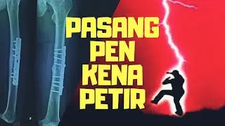 Pasang Pen Patah Tulang disambar Petir? | Mitos atau Fakta