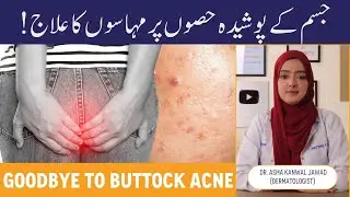 How To Treat Buttock Acne - Treatment Of Pimples On Buttocks - Reason For Blackheads - Treatment ...