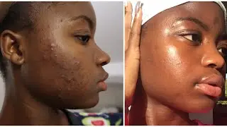 Bilan 2 mois Traitement curacné/roaccutane/ Accutane Treatment Peau noire/dark skin