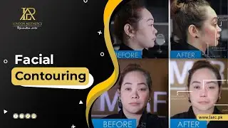 Facial Contouring  | London Aesthetics & Rejuvenation Centre