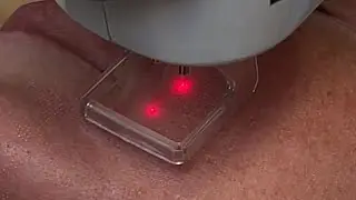 Laser frakcyjny CO2