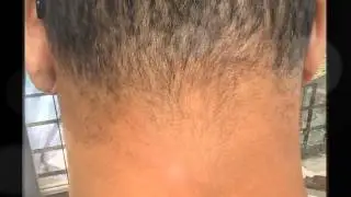 pro alopeciata treatment progress