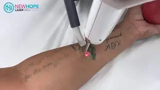 Laser Tattoo Removal - Removing Quote Tattoo off Forearm - Newhope Laser Skin Care - Orange County
