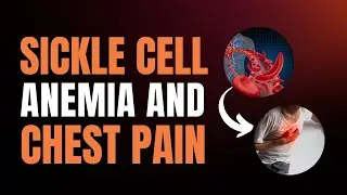 Why Chest Pain in Sickle Cell Anemia Could Be a Silent Killer?