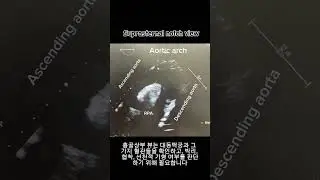 13일차 : Suprasternal notch view echo #suprasternal #aortic #echocardiography #심장초음파