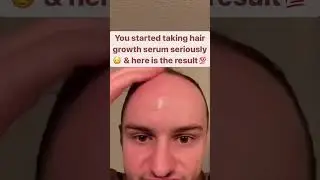 Watch the viral hair growth serum that&rsquo;s breaking the internet with the results, check now #shorts