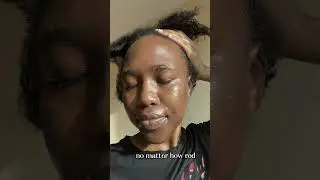 My PCOS acne journey update! Acne journey | PCOS acne| skincare transformation |hormonal acne