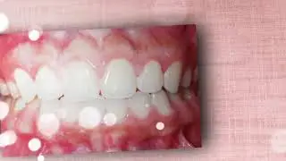 Good-bye to Your Gummy Smile with Laser Gum Recontouring in NYC | MyManhattanCosmeticDentist.com