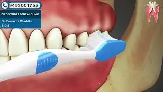 108  Perio Advantages and Disadvantages of Pocket Reduction Surgery