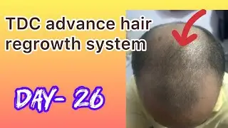 TDC advance hair regrowth system || day-26 || #tdc #haircare
