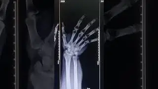 xray wrist ap/Scaphoid/lat