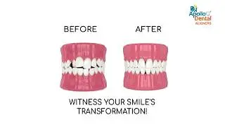 Apollo Dental Aligners: See How They Work!