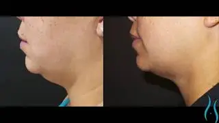 Kybella Injections in Connecticut
