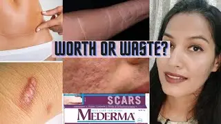 Mederma Scars Gel Worth or Waste? Burn scars,chiken pox scars,cut marks,acne scars,stretch marks