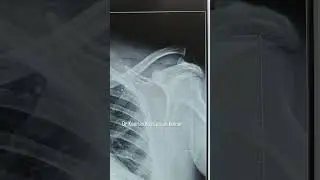 Arthroscopic assisted AC joint reconstruction. #upperlimbsurgeon #shouldersurgery #shouldersurgeon