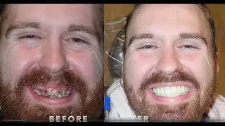 Teeth Now Buffalo vs All on 4, All on X