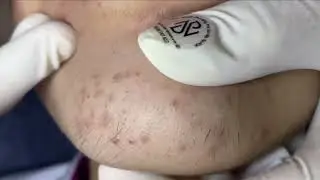 Acne On Girl's Chin | Acne Treatment Nhat Bang