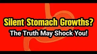 Are Fundic Gland Polyps Dangerous? What You Must Know!