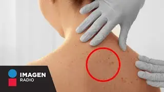 Signos de cáncer de piel tipo melanoma