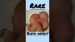 a very rare birth defect called as!!!! #educationalvideo #followformore #abnormality  #birthdefects