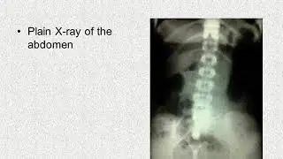 X RAY US CT MRI GOSSYBIOMA MISSED TOWEL,SPONGE,COTTON Ahmed Esawy