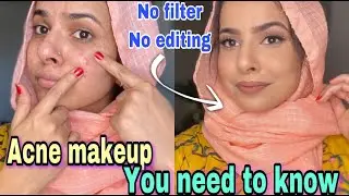 Flawless base for acne prone skin | How to treat and cover active acne, acne scars/pimple NON-CAKEY