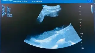 Obstetrics Ultrasound :  Abdominal - Pelvic cyst / collection