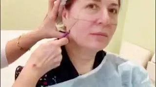 Get a Natural Youthful Look with PLLA Filler