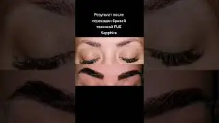 Пересадка бровей в Турции. Пересадка бровей техникой FUE Sapphire